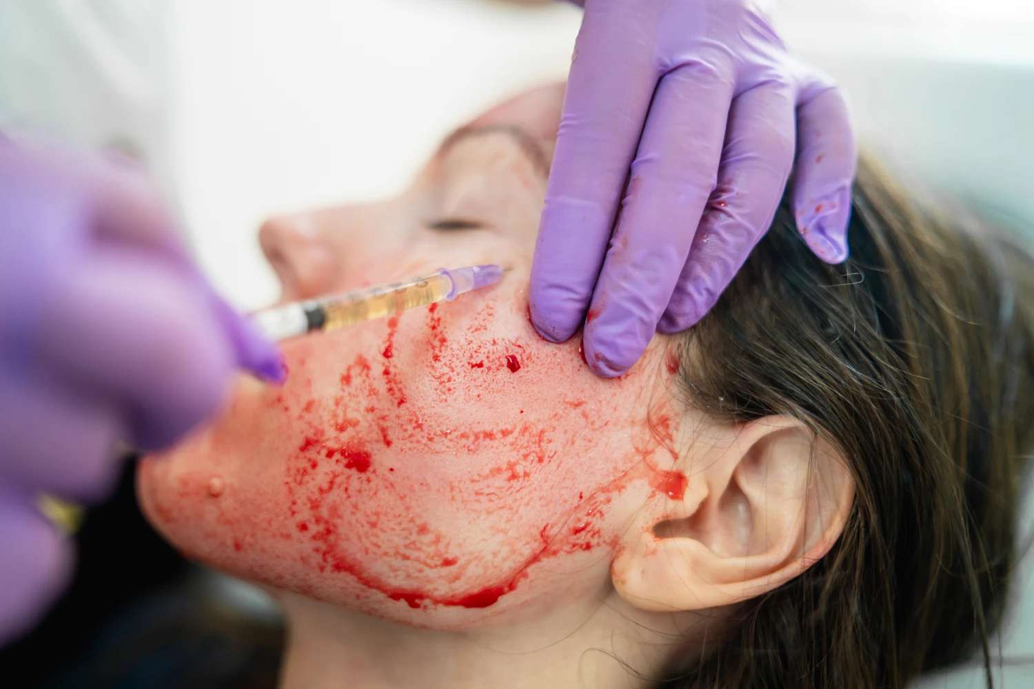 At Least Three Women Were Infected With H.I.V. After ‘Vampire Facials’